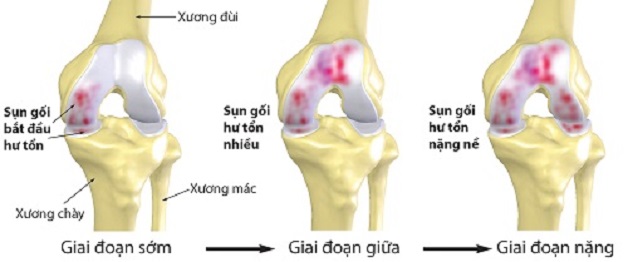 Thoái hóa khớp và nguy cơ bệnh tăng nặng trong mùa nóng