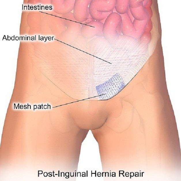 Thoát vị bẹn có nguy hiểm không? Cách điều trị bệnh hiệu quả