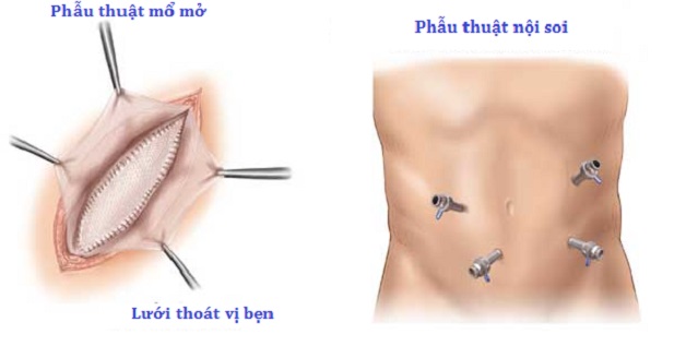 Thoát vị bẹn là thế nào? Tất tần tật những điều bạn cần biết