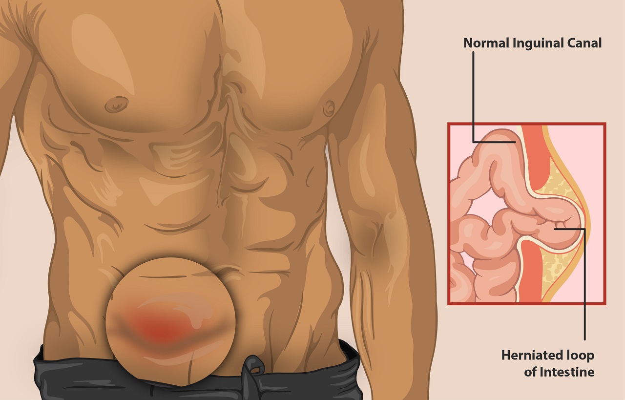 Thoát vị bẹn nghẹt là gì và được điều trị như thế nào?