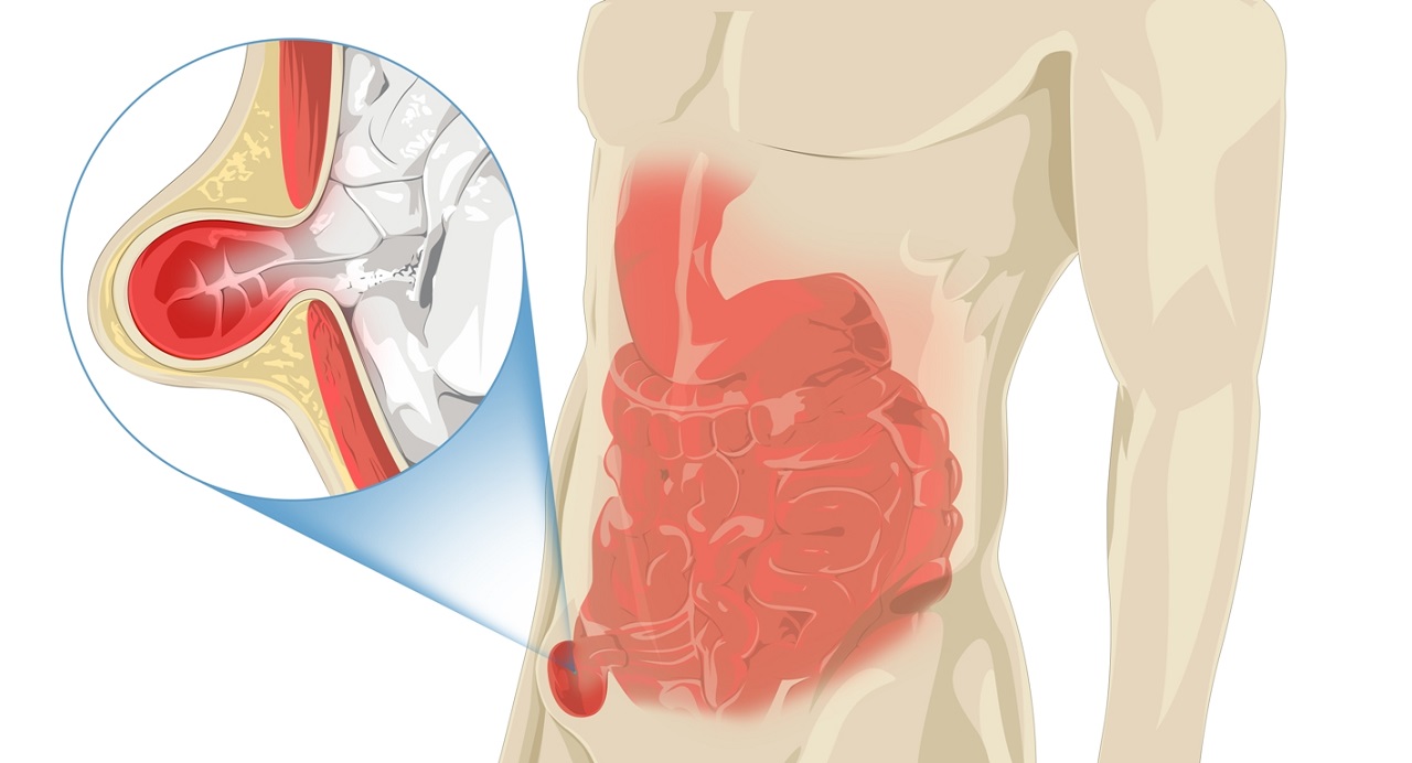 Thoát vị bẹn nghẹt: mức độ nguy hiểm và phương pháp điều trị