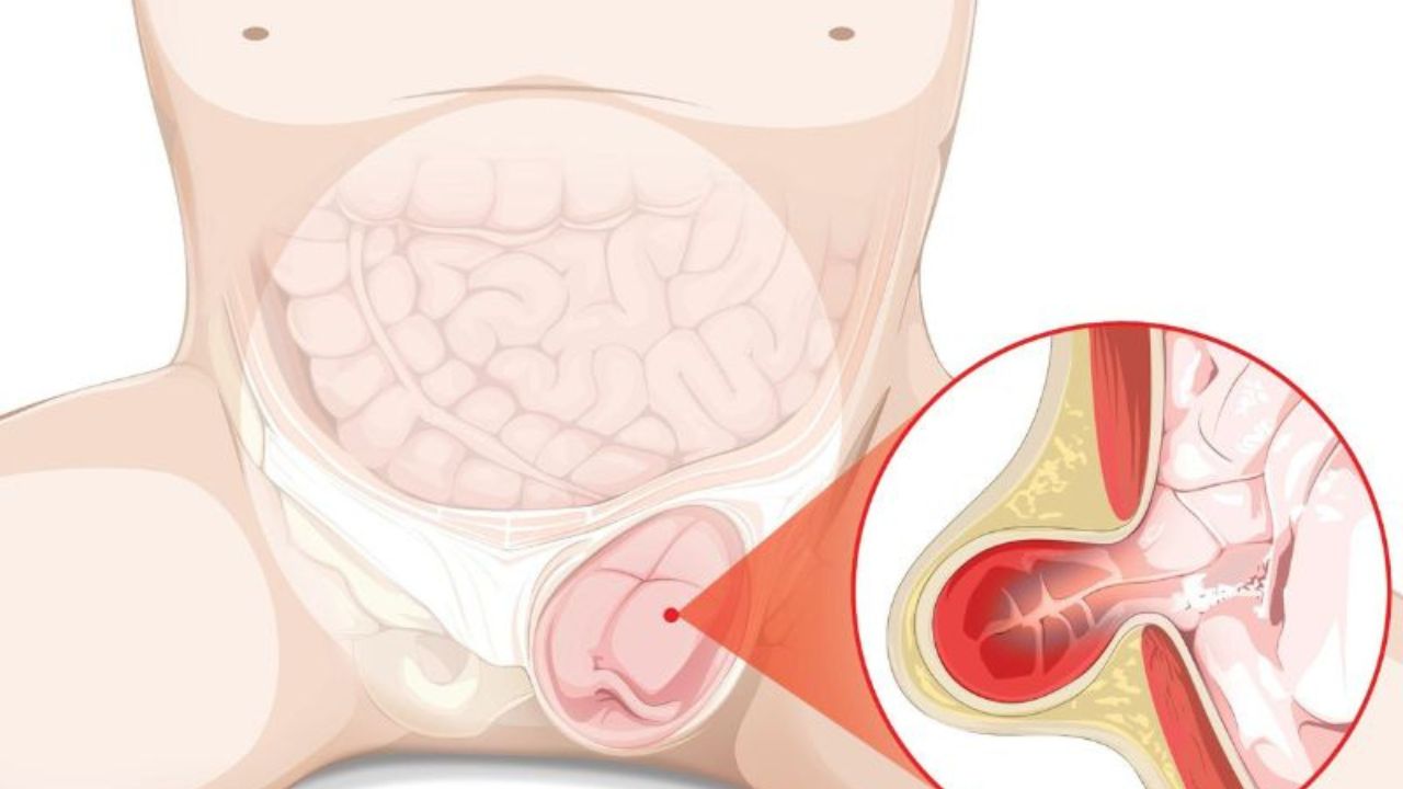 Thoát vị bẹn nghẹt: nguy hiểm vô cùng, cần phẫu thuật gấp