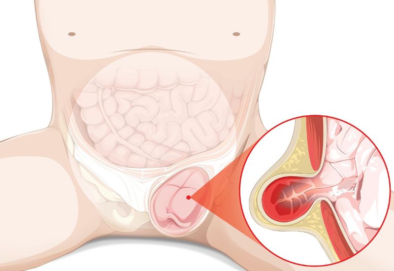 Thoát vị bẹn nghẹt: nguy hiểm vô cùng, cần phẫu thuật gấp