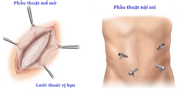 Thoát vị bẹn người già là gì? Nguyên nhân, triệu chứng