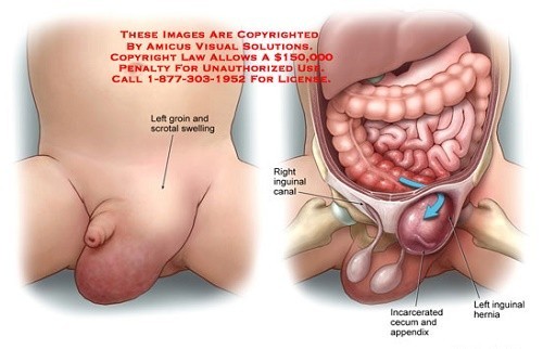 Thoát vị bẹn nguy hiểm như thế nào?