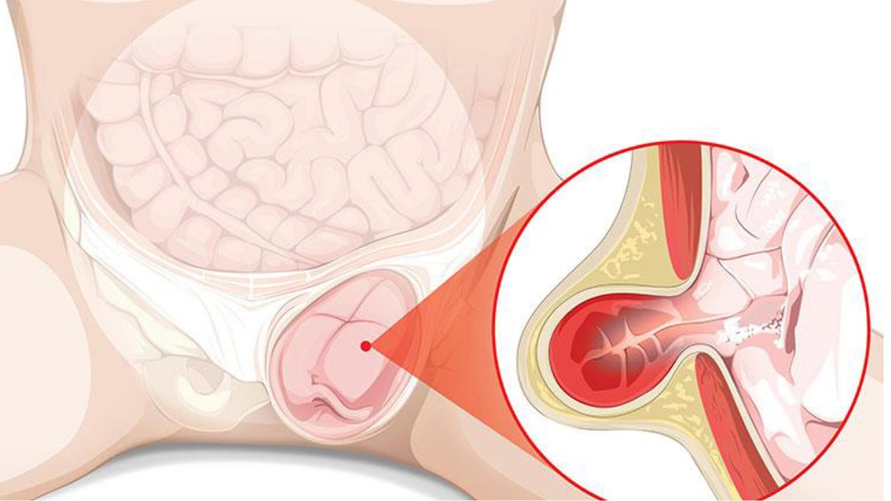 Thoát vị bẹn ở trẻ: dấu hiệu, biến chứng và cách điều trị