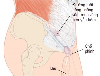 Thoát vị bẹn ở trẻ em cách nhận biết và điều trị