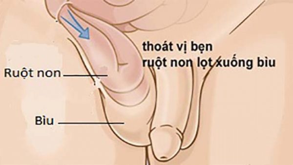 Thoát vị bẹn ở trẻ em cách nhận biết và điều trị