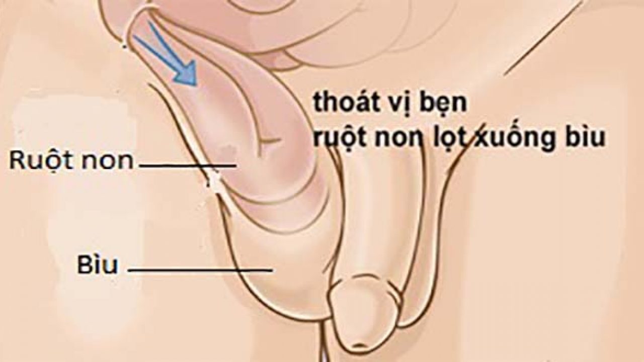 Thoát vị bẹn ở trẻ và những điều cần biết