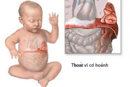 Thoát vị cơ hoành có nguy hiểm không?