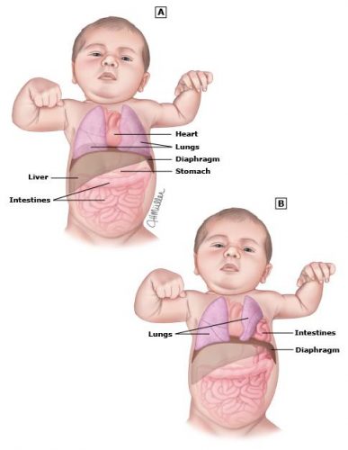 Thoát vị cơ hoành có nguy hiểm không?