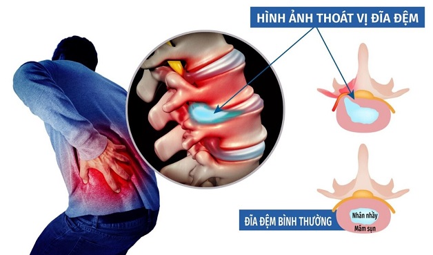 Thoát vị đĩa đệm có nguy hiểm không? Nhận biết và xử trí