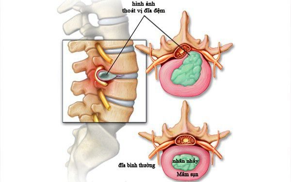 Thoát vị đĩa đệm có nguy hiểm không?