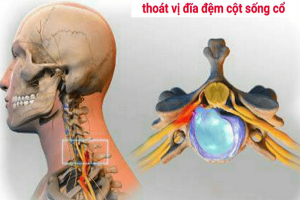 Thoát vị đĩa đệm cột sống cổ chớ chủ quan