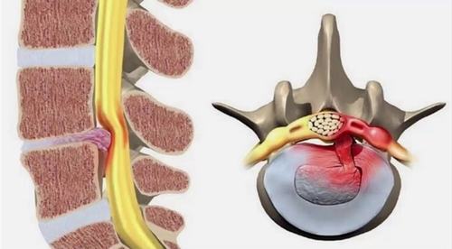 Thoát vị đĩa đệm cột sống lưng và những điều cần biết