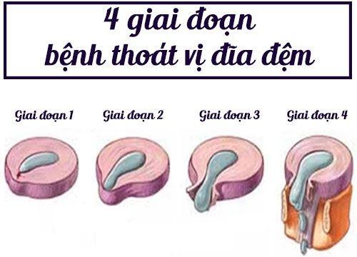 Thoát vị đĩa đệm cột sống lưng và những điều cần biết