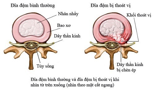 Thoát vị đĩa đệm cột sống thắt lưng