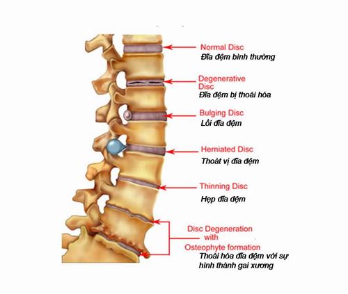 Thoát vị đĩa đệm đa tầng là gì? Phồng đĩa đệm có nguy hiểm không?