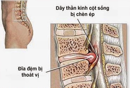 Thoát vị đĩa đệm dịch chuyển ra khỏi vị trí