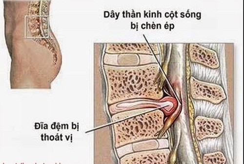 Thoát vị đĩa đệm độ 2