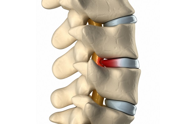 Thoát vị đĩa đệm gây hẹp ống sống: Không thể chủ quan!