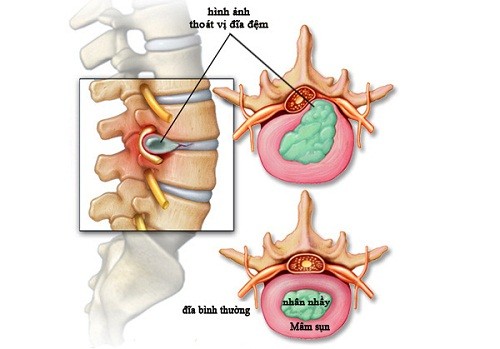 Thoát vị đĩa đệm gây tê chân