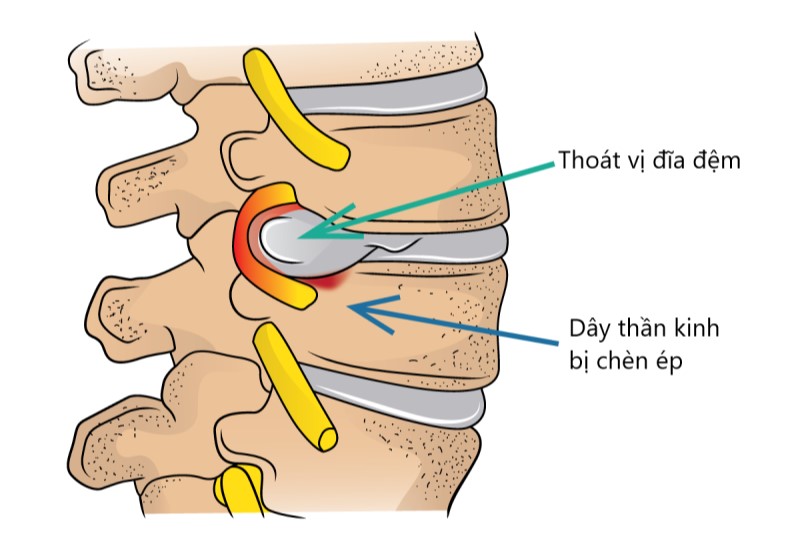 Thoát vị đĩa đệm L3 L4: Nguyên nhân, Triệu chứng và Điều trị