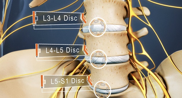 Thoát vị đĩa đệm l4 l5: Tìm hiểu từ nguyên nhân