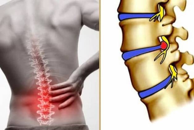 Thoát vị đĩa đệm ở người trẻ tuổi và cách phòng ngừa