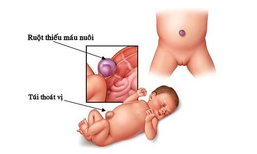 Thoát vị rốn là gì?