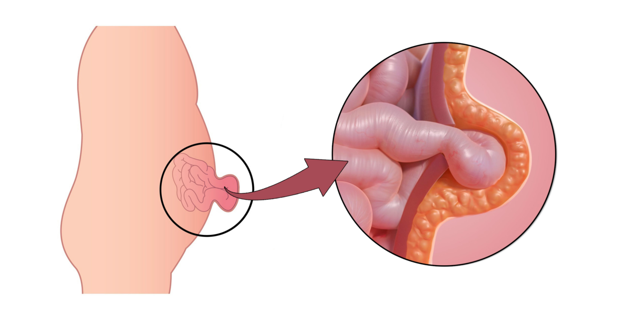 Thoát vị thành bụng ở trẻ sơ sinh: Nhận biết – điều trị