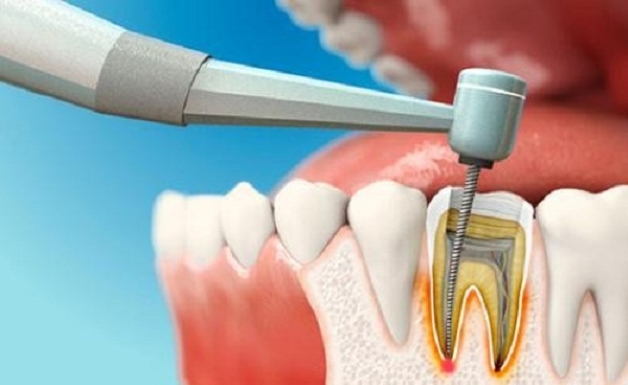 Thời điểm an toàn để điều trị tủy răng cho bà bầu