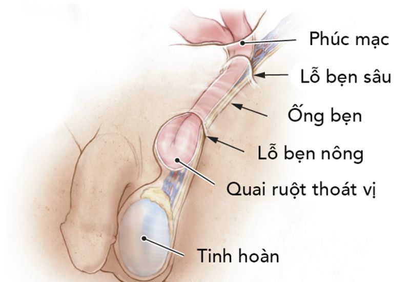 Thời điểm mổ thoát vị bẹn và phương pháp ưu việt hiện nay