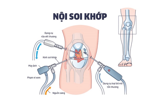 Thời điểm nên thực hiện nội soi khớp gối