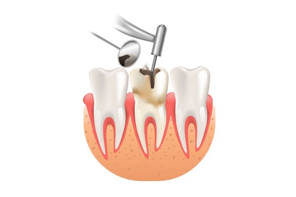 Thời gian điều trị tủy răng kéo dài bao lâu?