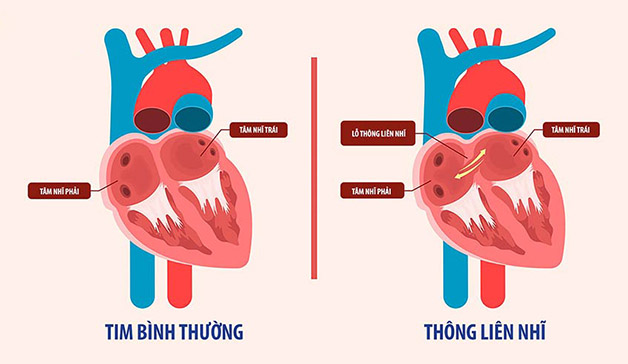 Thông liên nhĩ bẩm sinh, mẹ bầu vẫn bản lĩnh để vượt cạn thành công