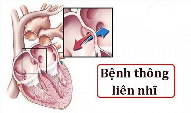 Thông liên nhĩ: Bệnh tim bẩm sinh không thể coi thường!