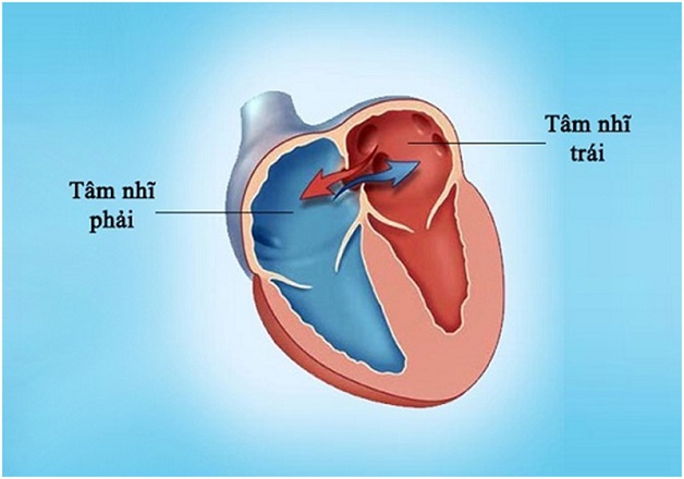 Thông liên nhĩ: Triệu chứng, chẩn đoán và điều trị