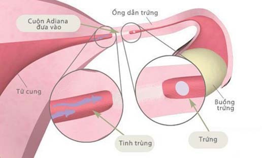 Thông ống dẫn trứng những nguyên nhân gây vô sinh