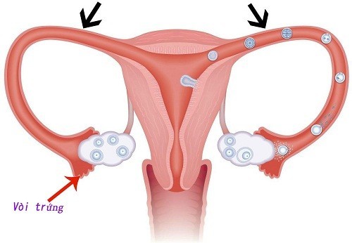 Thông tắc vòi trứng, ống dẫn trứng