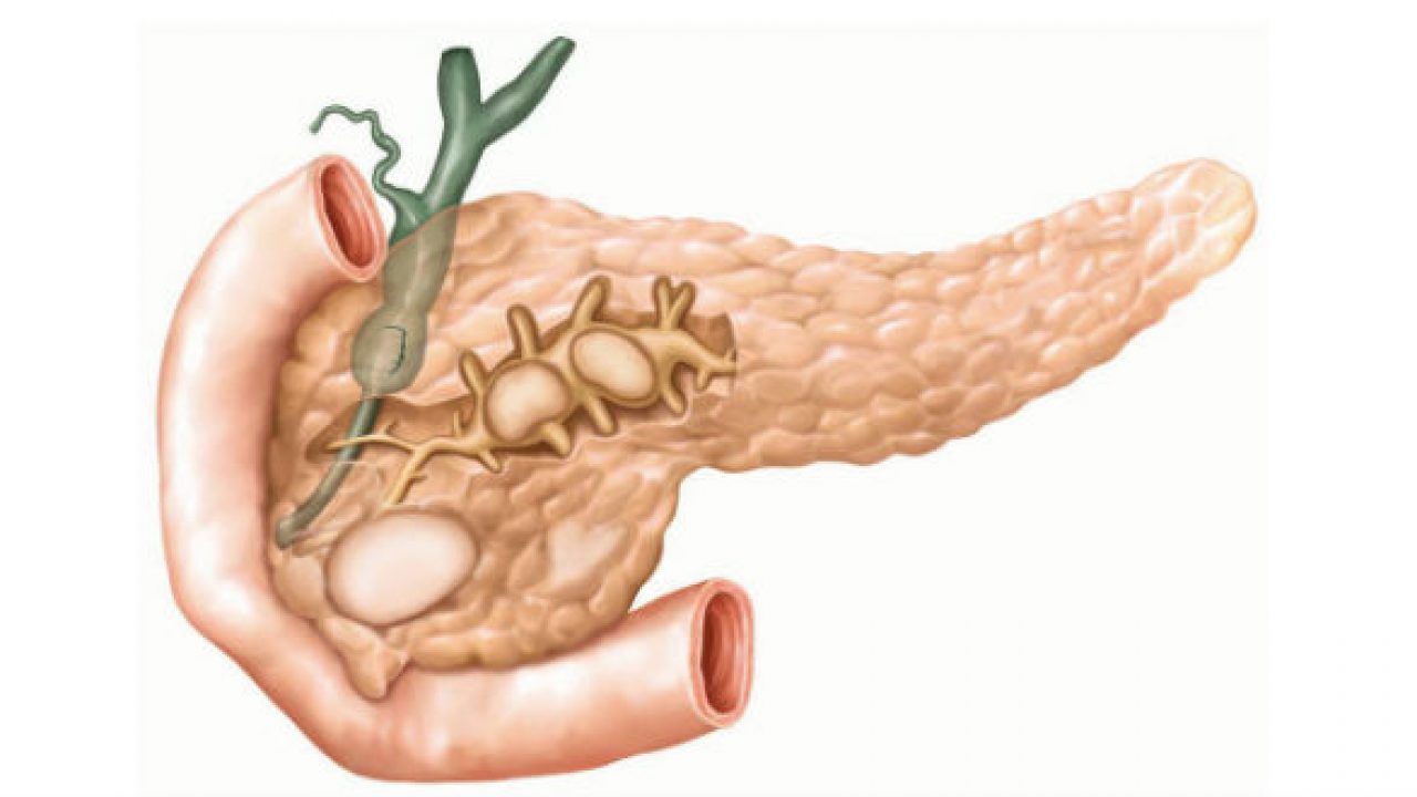 Thông tin cần biết cho những người bị viêm tụy