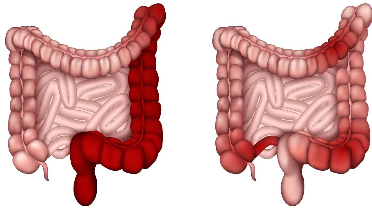 Thông tin cần biết về bệnh crohn bệnh học