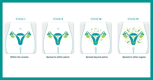 Thông tin cần biết về ung thư buồng trứng giai đoạn cuối