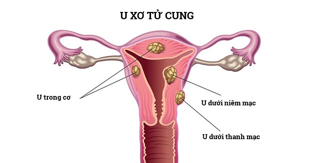 Thông tin chi tiết về phương pháp nút mạch u xơ tử cung