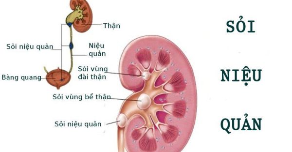 Thông tin quan trọng về nội soi tán sỏi niệu quản bằng laser