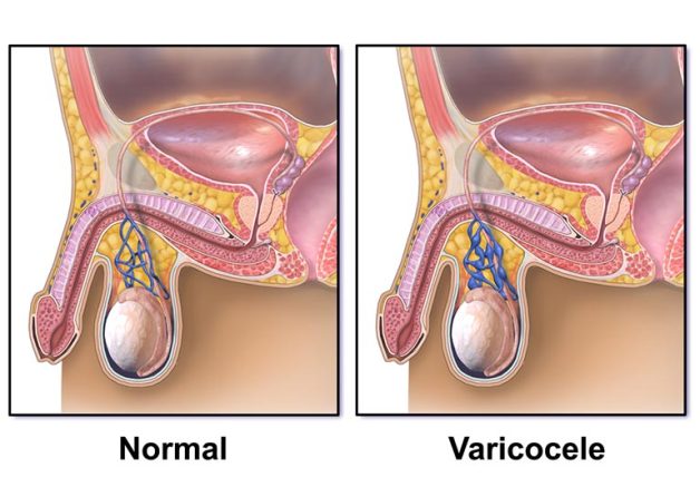 Thông tin về bệnh giãn tĩnh mạch thừng tinh là gì? 
