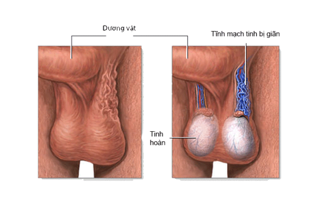 Thông tin về bệnh giãn tĩnh mạch thừng tinh là gì? 