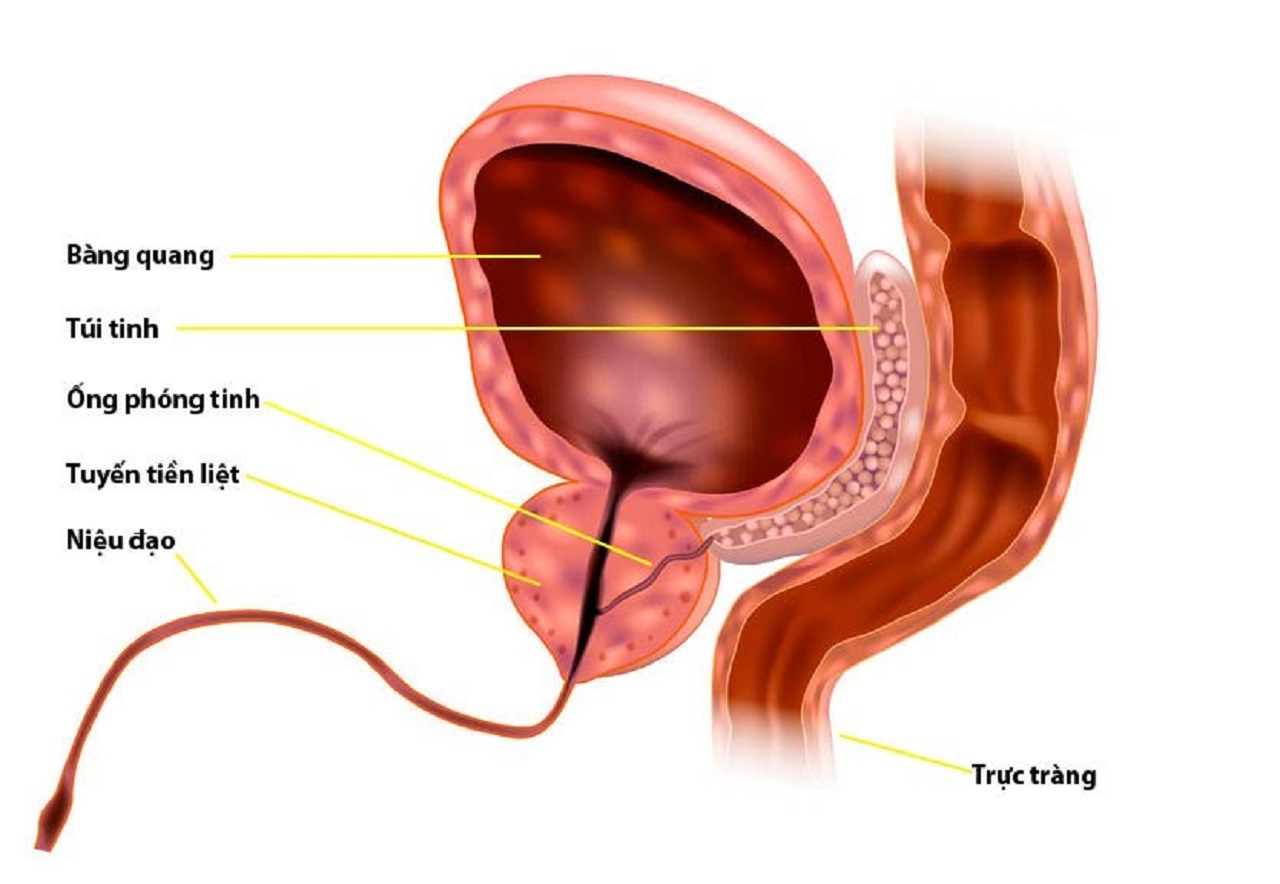 Thông tin về bệnh sỏi niệu đạo tiền liệt tuyến