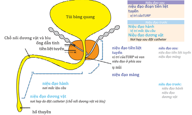 Thông tin về bệnh sỏi niệu đạo tiền liệt tuyến