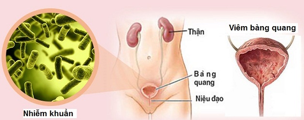 Thông tin về bệnh viêm đường tiết niệu viêm bàng quang 